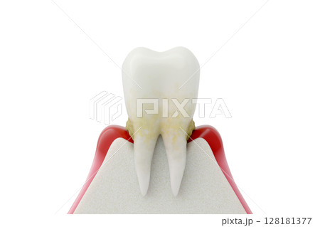 歯周病の症状 歯石の付着と進行した歯肉退縮 3DCG 128181377