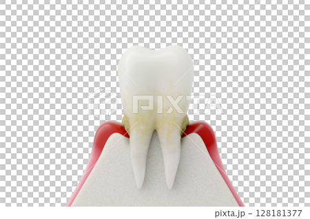 歯周病の症状 歯石の付着と進行した歯肉退縮 3DCG 128181377