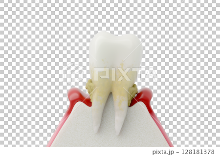 Illustration of severe periodontal disease, terminal symptoms of alveolar bone resorption and loose teeth Illustration of severe periodontal disease, terminal symptoms of alveolar bone resorption and loose teeth 128181378
