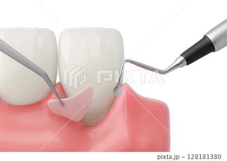 歯周病による歯肉退縮を治療する歯肉移植術の3DCGイラスト 128181380