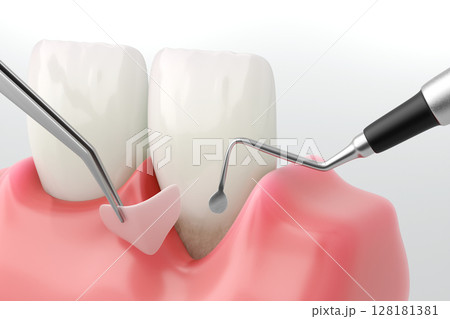 歯科における歯周病治療 歯肉移植手術のリアルな3DCG 歯科における歯周病治療 歯肉移植手術のリアルな3DCG 128181381