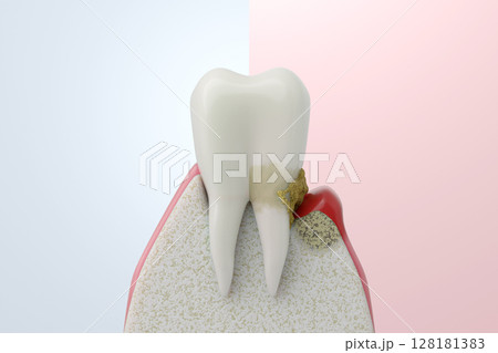 健康な歯茎と歯周病の比較イメージ ビフォーアフターのコンセプトイラスト 128181383