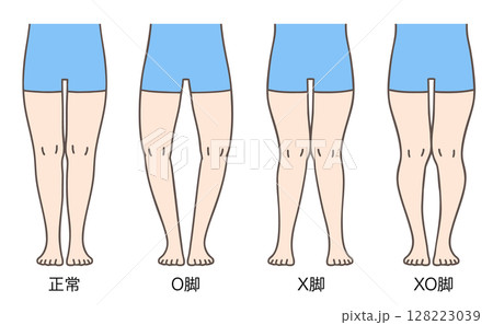 正常な脚、O脚、X脚、XO脚の姿勢とプロポーション 128223039