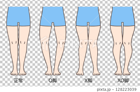 正常な脚、O脚、X脚、XO脚の姿勢とプロポーション 128223039