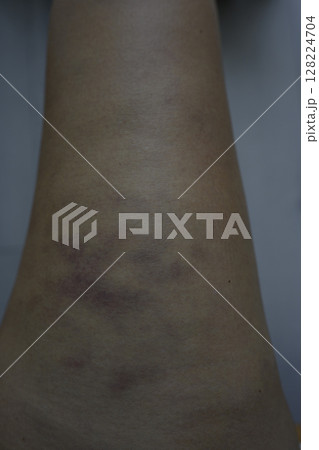 Bruises on the hips and thighs after cellulite treatments Bruises on the hips and thighs after cellulite treatments 128224704
