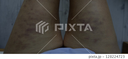 Bruises on the hips and thighs after cellulite treatments Bruises on the hips and thighs after cellulite treatments 128224723