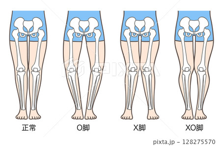 正常な脚、O脚、X脚、XO脚の姿勢と骨格 正常な脚、O脚、X脚、XO脚の姿勢と骨格 128275570