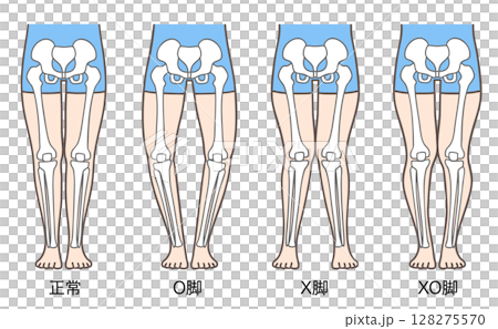 正常な脚、O脚、X脚、XO脚の姿勢と骨格 正常な脚、O脚、X脚、XO脚の姿勢と骨格 128275570