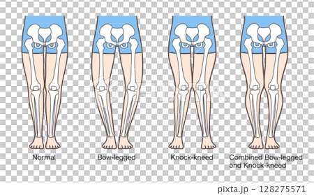 Posture and skeleton of normal legs, bow legs, knock-knees and knock-knees Posture and skeleton of normal legs, bow legs, knock-knees and knock-knees 128275571