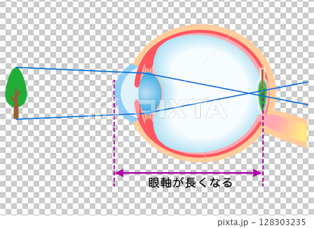 Structure of the eye, axial myopia, visual acuity 128303235