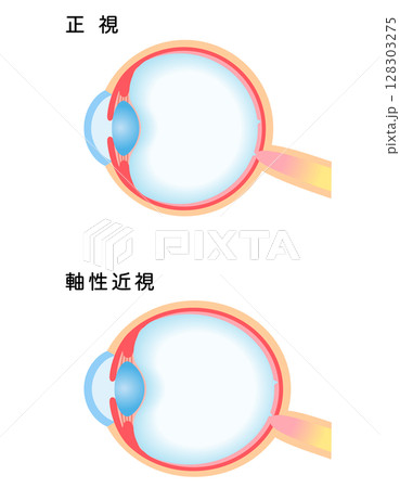 目の構造　正視と軸性近視　視力 128303275