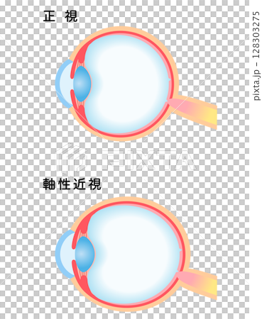 Structure of the eye: normal vision and axial myopia, visual acuity 128303275