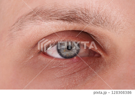 Macro shot of a human eye with purulent inflammation of barley. Hordeolum is an acute purulent inflammation of the hair follicle of the eyelashes or the sebaceous gland of the eyelash. Macro shot of a human eye with purulent inflammation of barley. Hordeolum is an acute purulent inflammation of the hair follicle of the eyelashes or the sebaceous gland of the eyelash. 128308386