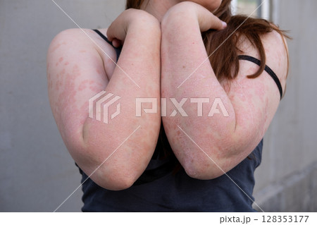 Psoriasis. Acute psoriasis of the elbows is an autoimmune incurable dermatological skin disease. It is characterized by extensive, red, inflamed, flaky rash. 128353177