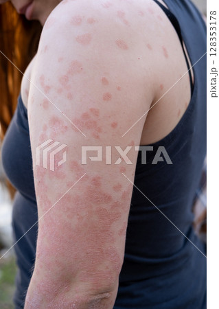 Psoriasis. Acute psoriasis of the hands, wrists, elbows is an autoimmune incurable dermatological skin disease. It is characterized by extensive, red, inflamed, flaky rash. 128353178