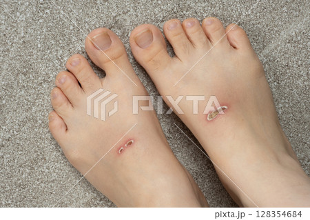 Abrasions on Top of Feet After Swimming with Fins 128354684