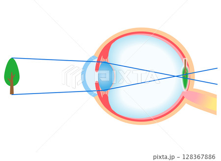 目の構造　軸性近視　視力 128367886
