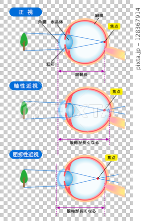 Structure of the eye, normal vision, axial myopia, refractive myopia, visual acuity Structure of the eye, normal vision, axial myopia, refractive myopia, visual acuity 128367914