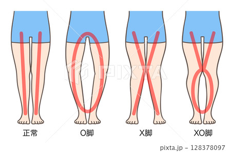正常な脚、O脚、X脚、XO脚、女性の下肢 128378097