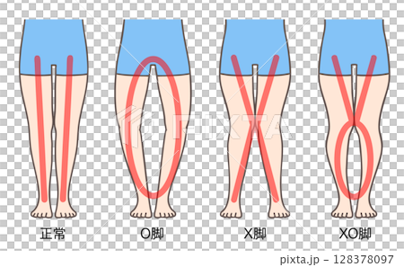 正常な脚、O脚、X脚、XO脚、女性の下肢 128378097