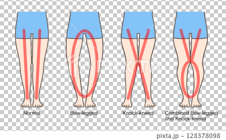 正常腿、O型腿、膝蓋內翻、XO型腿、女性小腿 正常腿、O型腿、膝蓋內翻、XO型腿、女性小腿 128378098