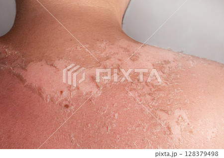 Sunburn on the skin. Back of a man who was burned in the sun. Skin from the burn. Flaky skin from allergies, peeling or eczema. Dry skin in need of treatment and hydration. Sunburn on the skin. Back of a man who was burned in the sun. Skin from the burn. Flaky skin from allergies, peeling or eczema. Dry skin in need of treatment and hydration. 128379498