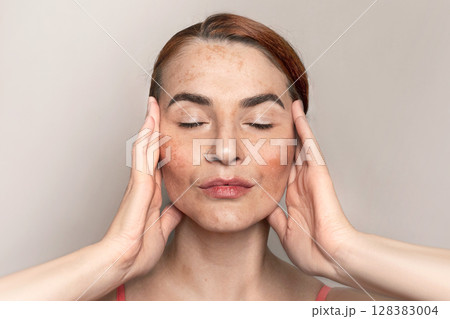 Caucasian woman face with pigmentation, melasma, freckles, age spots photo. Close up Caucasian woman face with pigmentation, melasma, freckles, age spots photo. Close up 128383004