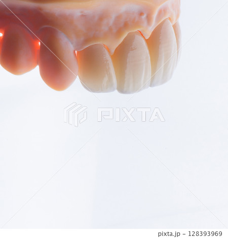 High-quality four dental crowns made of zirconium for fixation to the frontal teeth of upper jaw. High-quality four dental crowns made of zirconium for fixation to the frontal teeth of upper jaw. 128393969