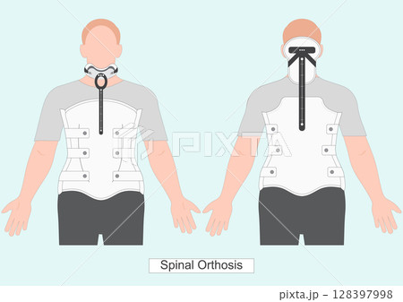 Milwaukee brace or TLSO is a rigid spinal Orthosis. 128397998