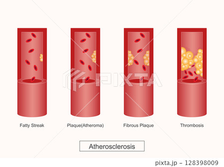 Atherosclerosis is a disease where plaque builds up inside arteries. Atherosclerosis is a disease where plaque builds up inside arteries. 128398009