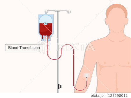 Blood transfusion is a medical procedure where blood. Blood transfusion is a medical procedure where blood. 128398011