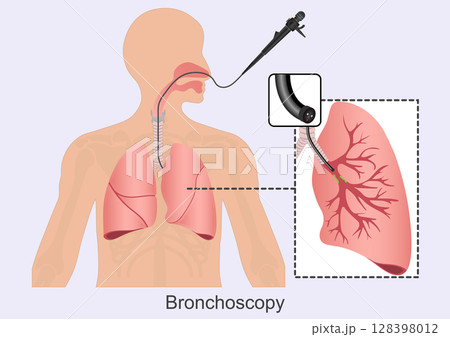 Bronchoscopy is a procedure that lets doctors look at lungs and air passages. 128398012