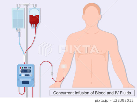 Concurrent infusion is one in which two drugs are simultaneously infused. 128398013