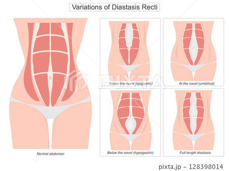 Diastasis recti is a condition where the rectus abdominis the six-pack muscles separate along. 128398014