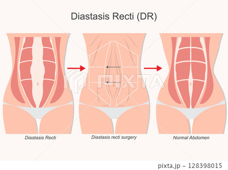 Diastasis recti surgery often part of a tummy tuck. 128398015