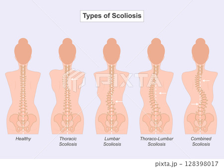 Female Scoliosis is a condition where the spine curves abnormally to the side. Female Scoliosis is a condition where the spine curves abnormally to the side. 128398017