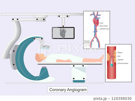 A coronary angiogram CAG is a test that uses X rays and contrast dye 128398030