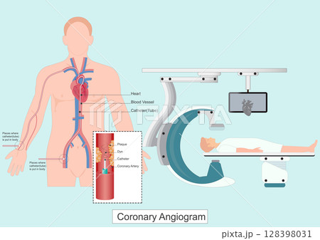 A coronary angiogram CAG is a test that uses X rays to look at the heart 128398031