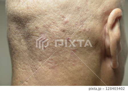 シニア後頭部の皮膚病 128403402