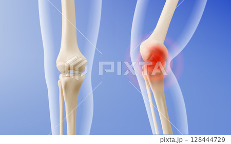 3d medical knee- healthy joint anatomy and painful 128444729