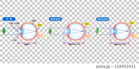 眼睛的結構、正常視力、軸心近視、屈光性近視、視力 128452431
