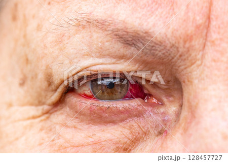 Elderly woman with bleeding eye indoors, serious pain expression 128457727