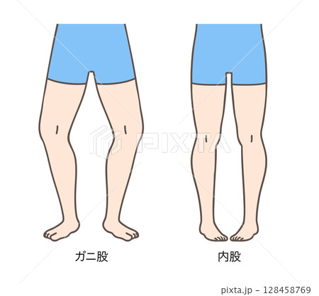 ガニ股と内股の女性、下肢の外旋と内旋 128458769