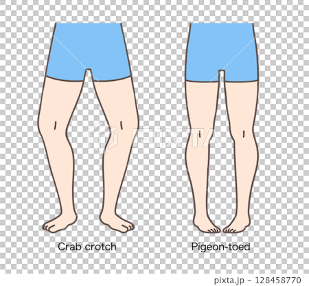 患有羅圈腿和膝內翻的女性，下肢外旋和內旋 128458770