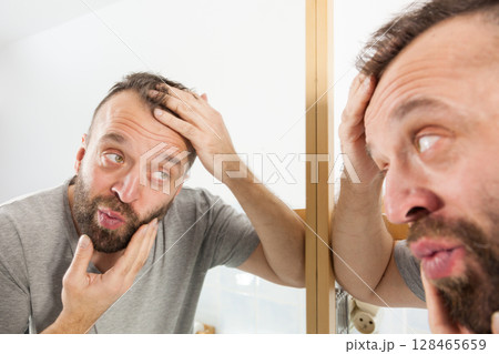 Worried man looking at his decreasing hairline Worried man looking at his decreasing hairline 128465659