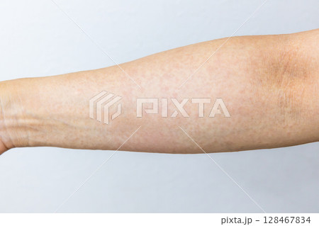 右腕の汗疹 128467834