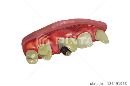 むし歯イラスト上顎 奥歯 むし歯イラスト上顎 奥歯 128491988