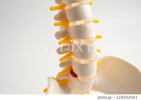 Lumbar spine displaced herniated disc fragment, spinal nerve and bone. Model for treatment medical in the orthopedic department. Lumbar spine displaced herniated disc fragment, spinal nerve and bone. Model for treatment medical in the orthopedic department. 128502041