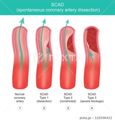 Types of Spontaneous Coronary Artery Dissection (SCAD). Illustrates. 128506422