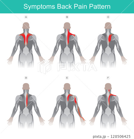 A series of anatomical diagrams illustrating various common patterns of back pain and referred pain in the human upper back, shoulders, and arms. 128506425